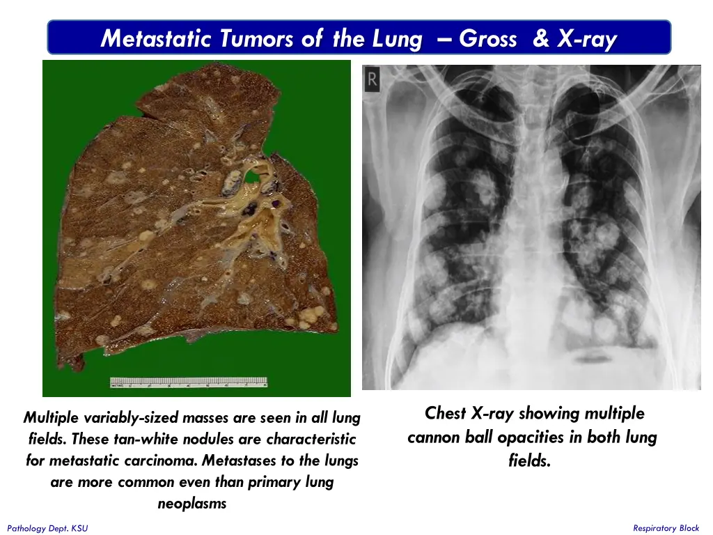 metastatic tumors of the lung gross x ray