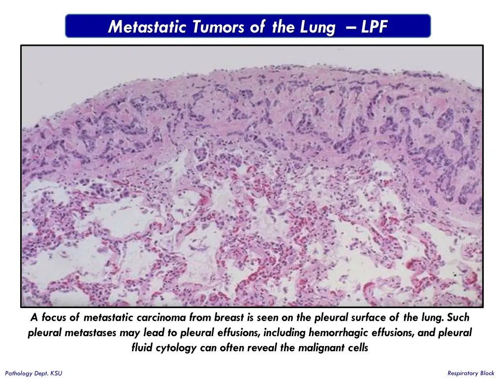 metastatic tumors of the lung lpf 1