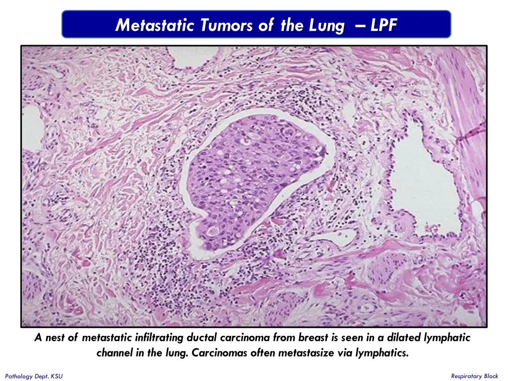 metastatic tumors of the lung lpf