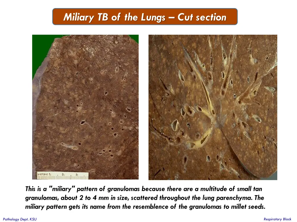 miliary tb of the lungs cut section