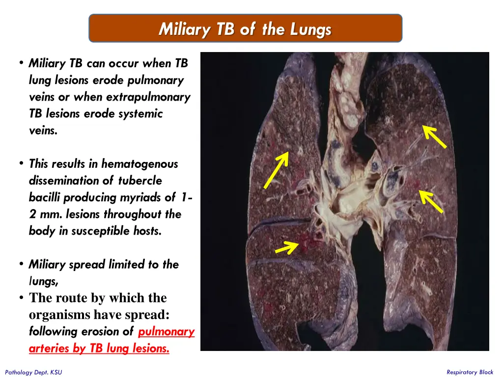 miliary tb of the lungs