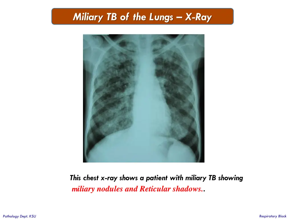 miliary tb of the lungs x ray