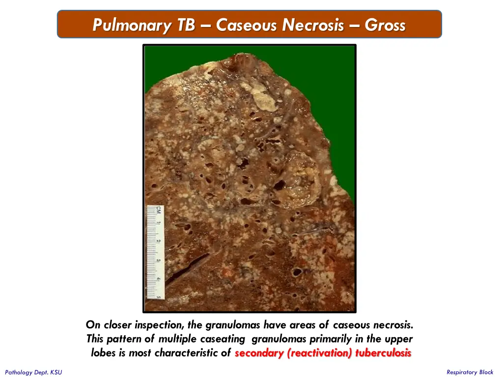 pulmonary tb caseous necrosis gross 1