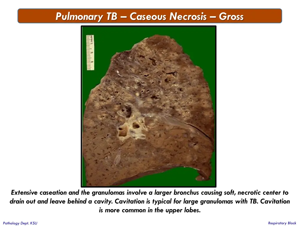 pulmonary tb caseous necrosis gross