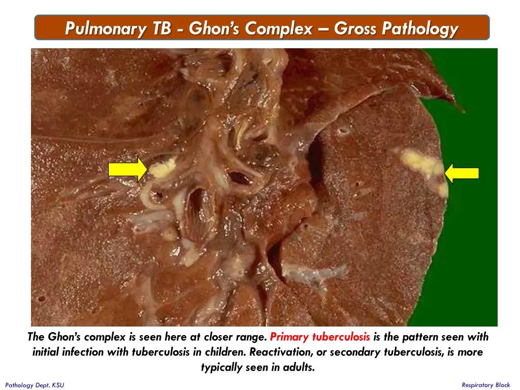 pulmonary tb ghon s complex gross pathology