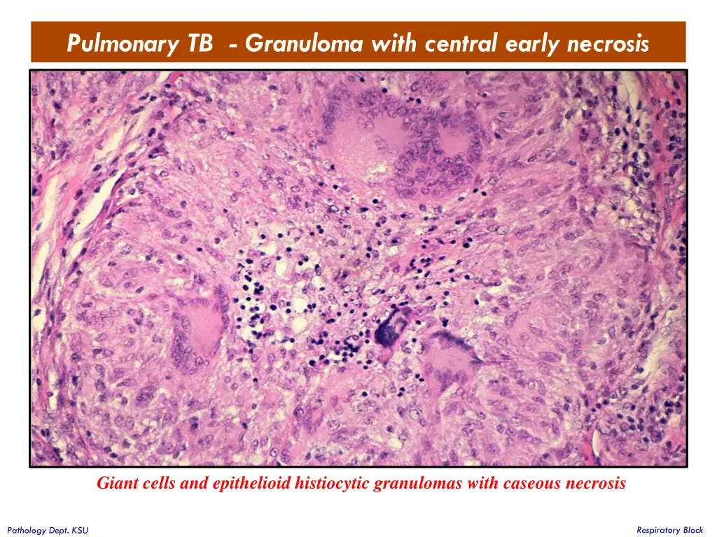 pulmonary tb granuloma with central early necrosis