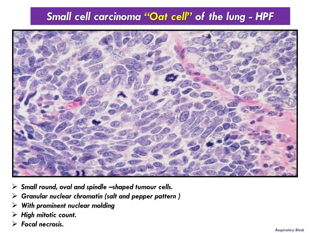 small cell carcinoma oat cell of the lung hpf