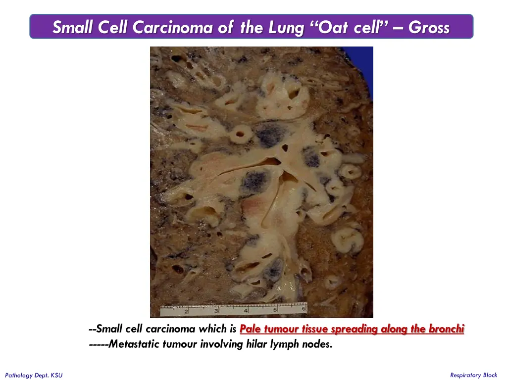 small cell carcinoma of the lung oat cell gross 1