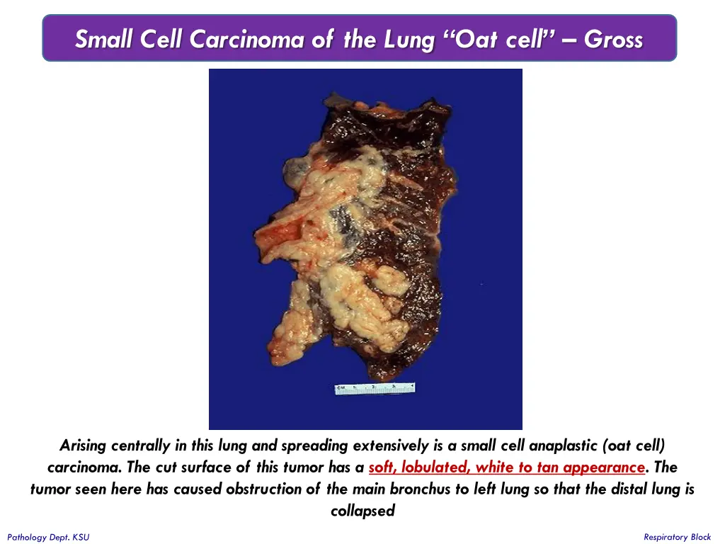 small cell carcinoma of the lung oat cell gross