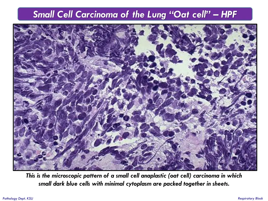 small cell carcinoma of the lung oat cell hpf