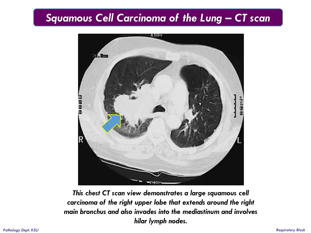 squamous cell carcinoma of the lung ct scan