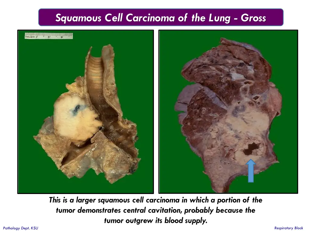 squamous cell carcinoma of the lung gross 1