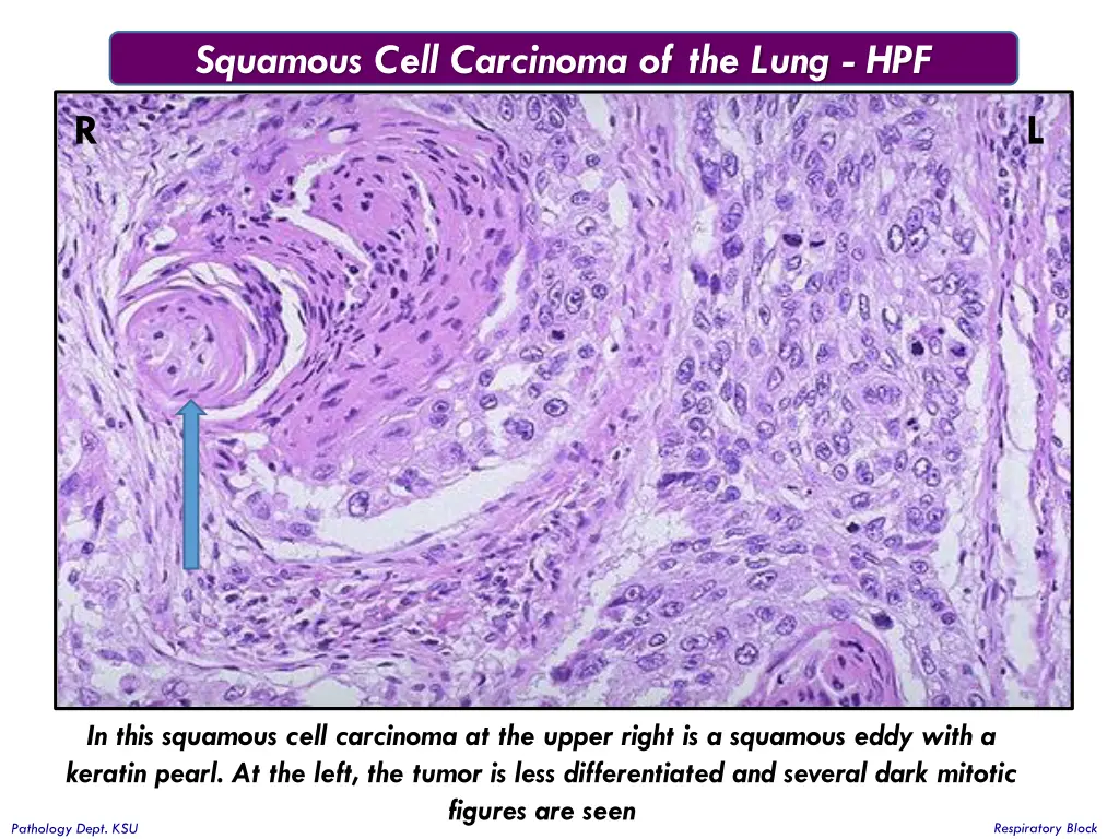 squamous cell carcinoma of the lung hpf 1