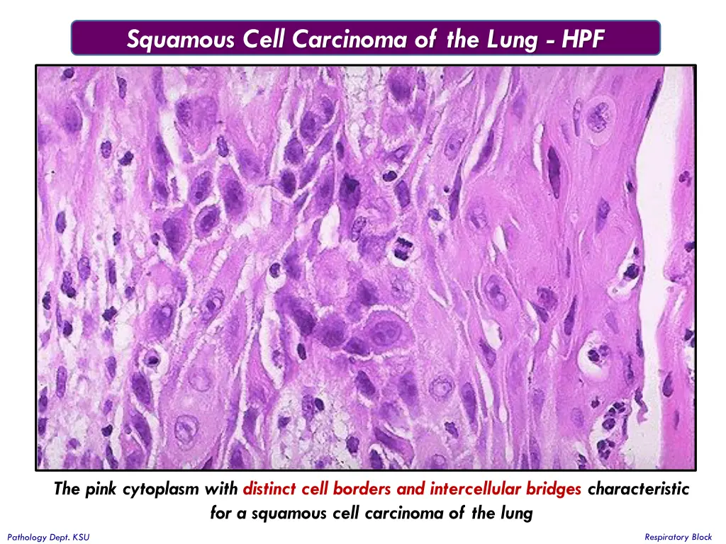 squamous cell carcinoma of the lung hpf 2