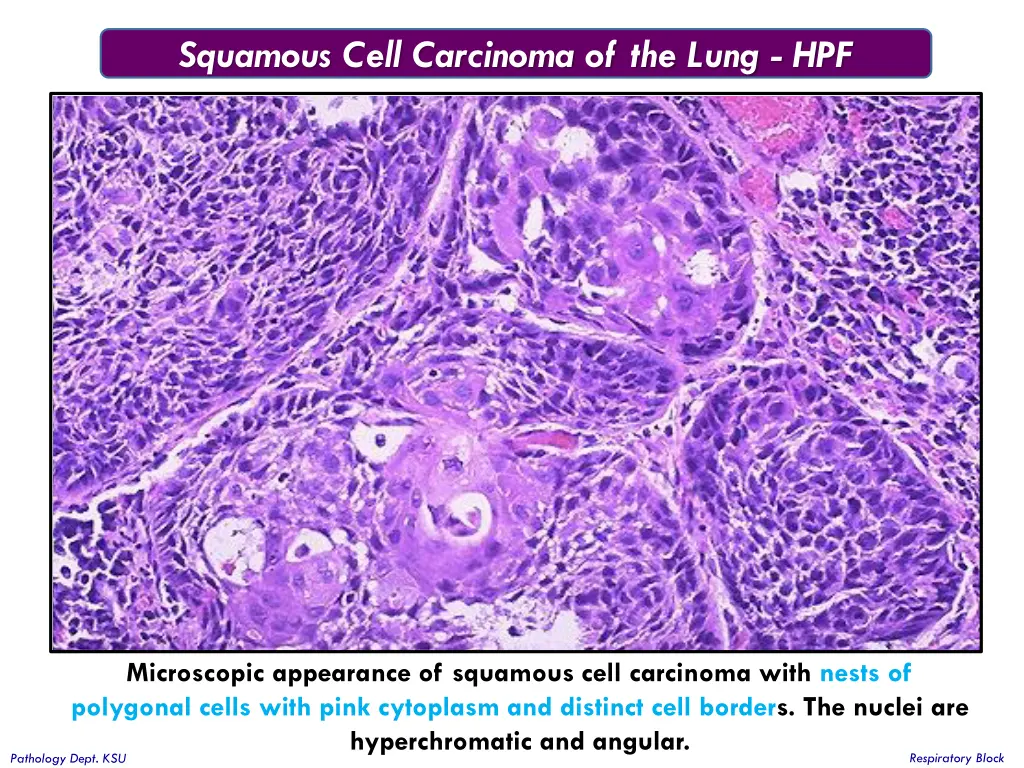 squamous cell carcinoma of the lung hpf