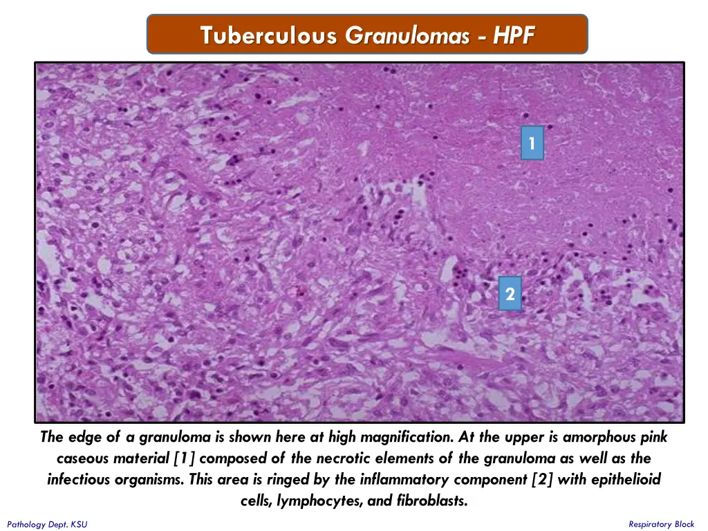 tuberculous granulomas hpf 1