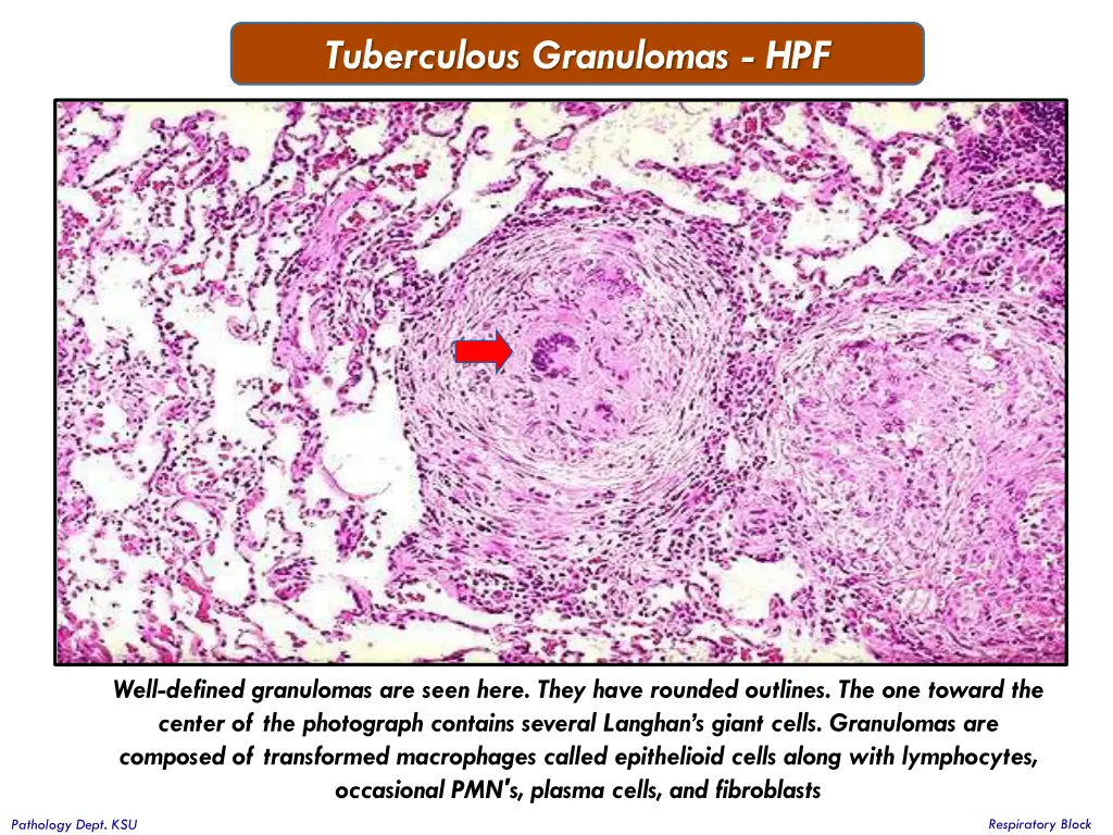 tuberculous granulomas hpf