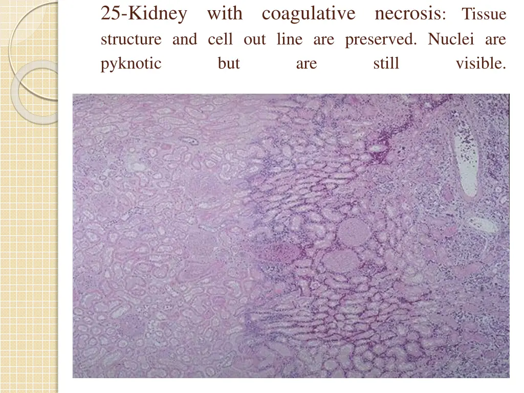 25 kidney with coagulative necrosis tissue