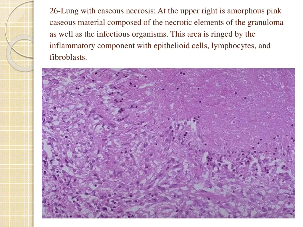 26 lung with caseous necrosis at the upper right