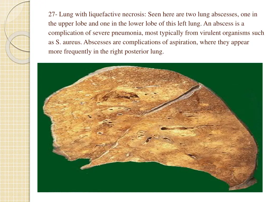 27 lung with liquefactive necrosis seen here