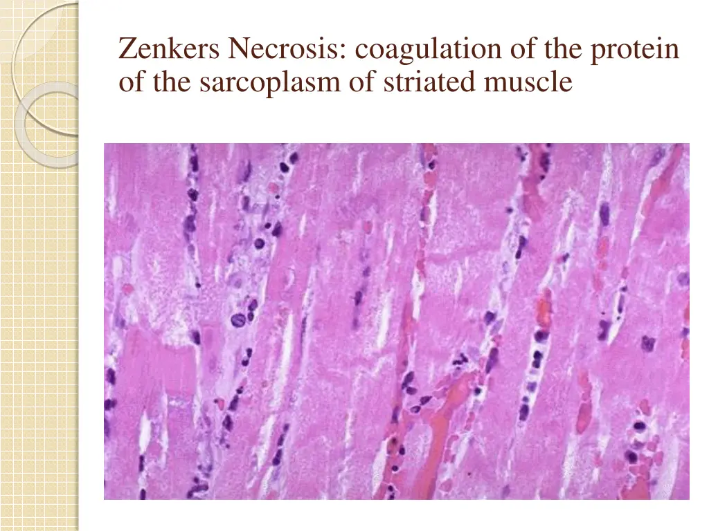 zenkers necrosis coagulation of the protein