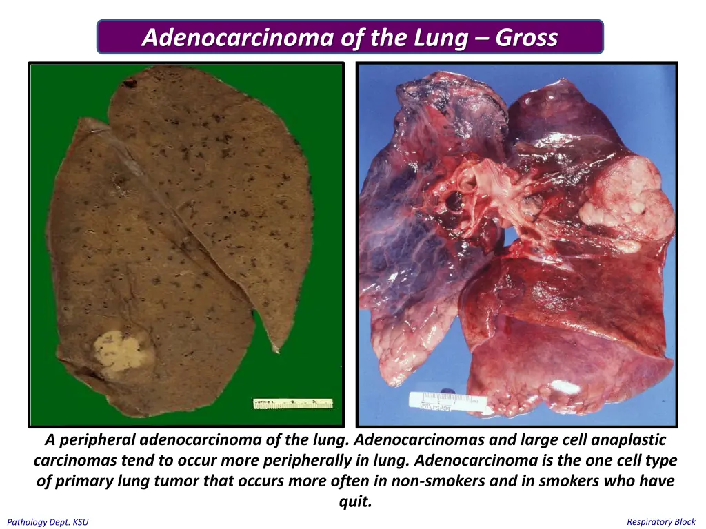 adenocarcinoma of the lung gross