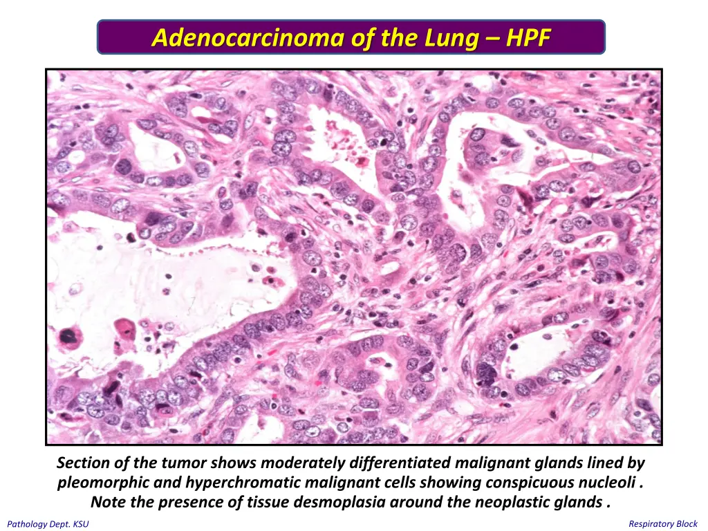 adenocarcinoma of the lung hpf