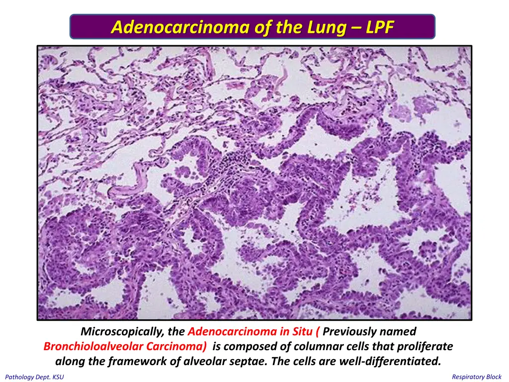 adenocarcinoma of the lung lpf