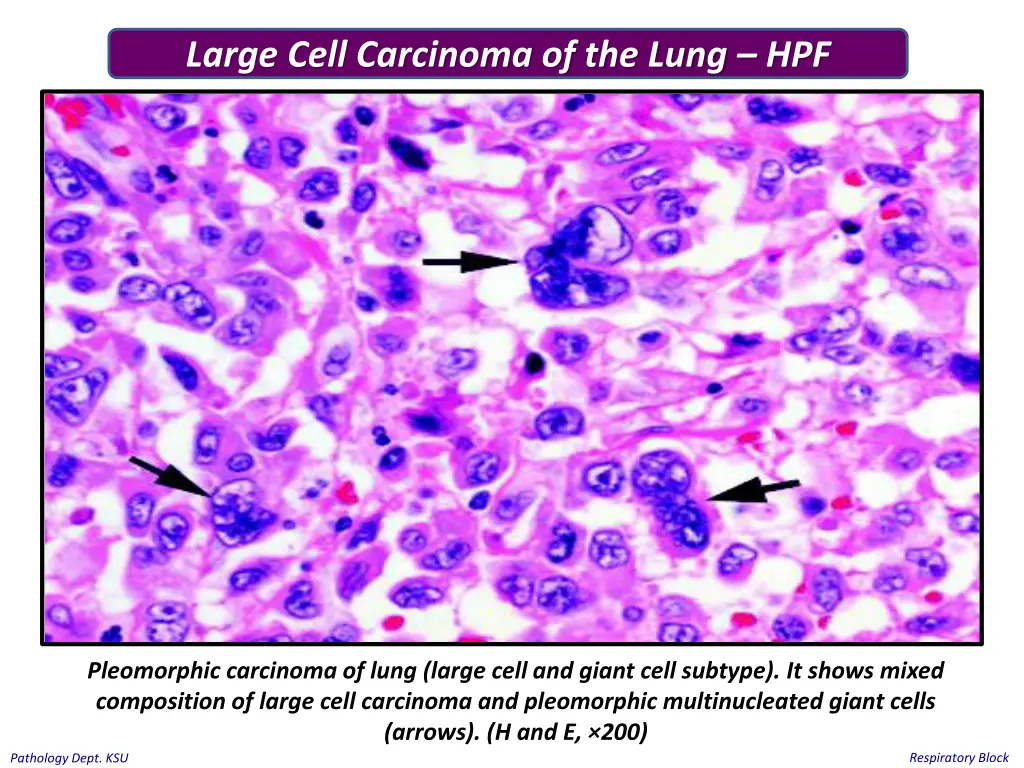 large cell carcinoma of the lung hpf