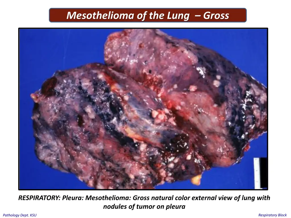 mesothelioma of the lung gross 1