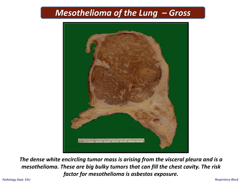 mesothelioma of the lung gross