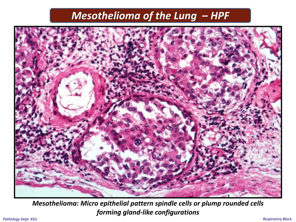 mesothelioma of the lung hpf