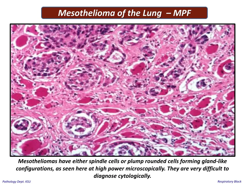 mesothelioma of the lung mpf