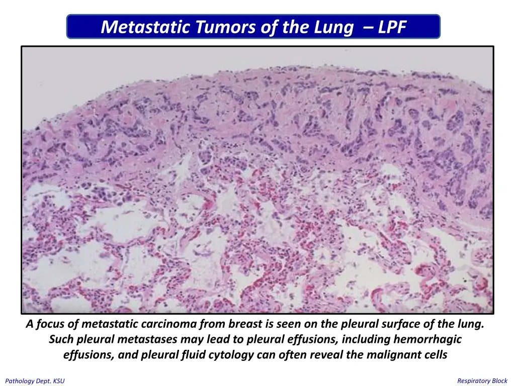 metastatic tumors of the lung lpf 1