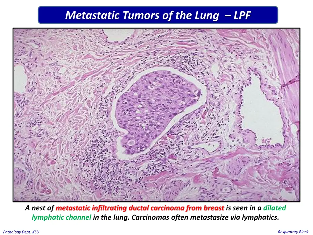 metastatic tumors of the lung lpf