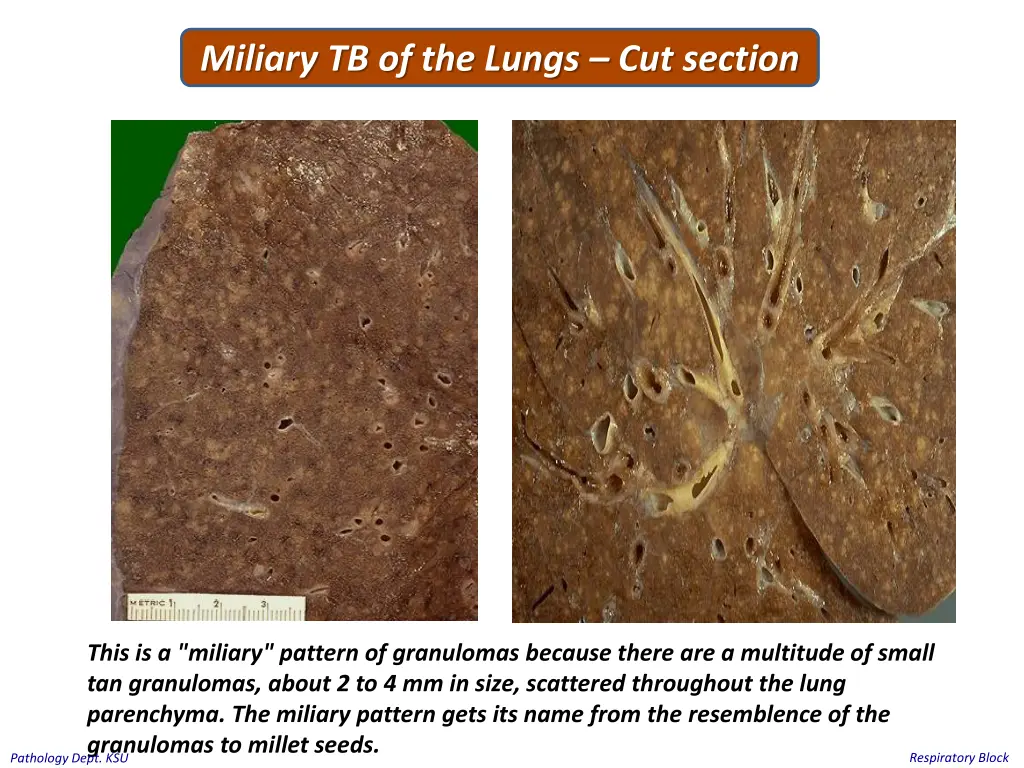 miliary tb of the lungs cut section