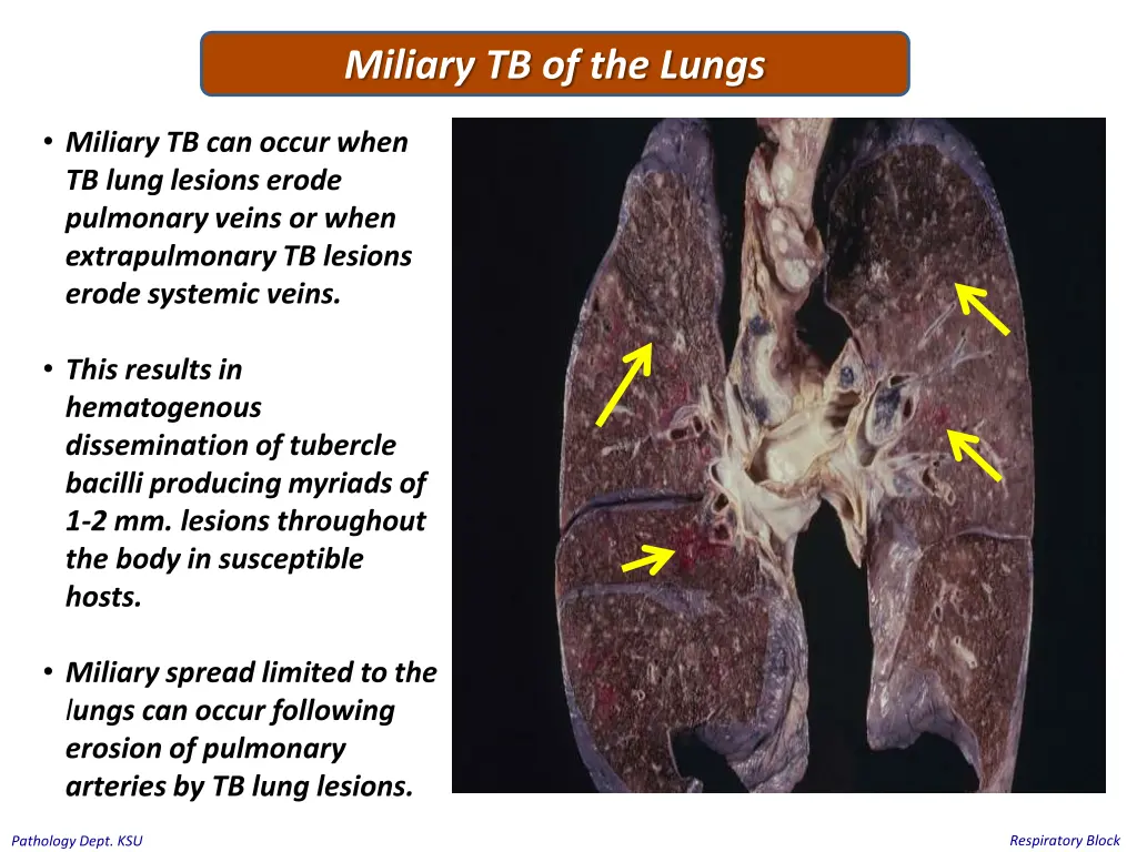 miliary tb of the lungs