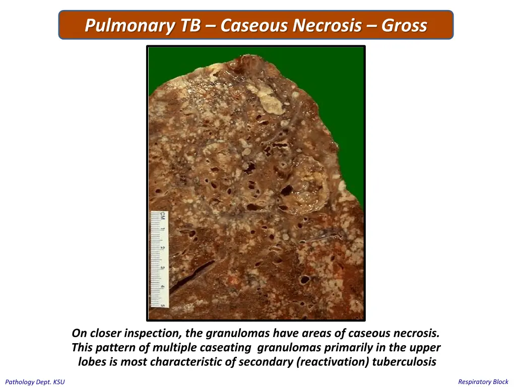 pulmonary tb caseous necrosis gross