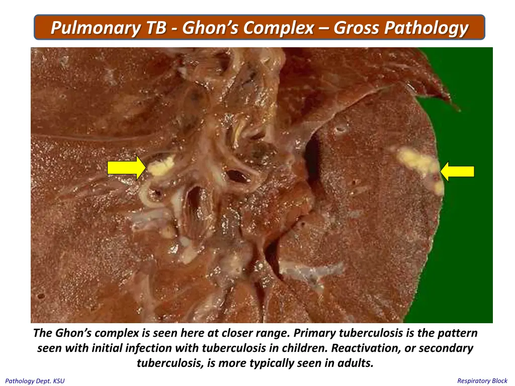 pulmonary tb ghon s complex gross pathology