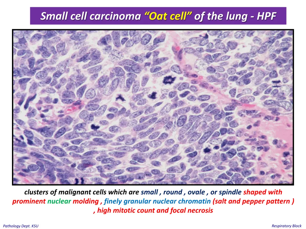 small cell carcinoma oat cell of the lung hpf