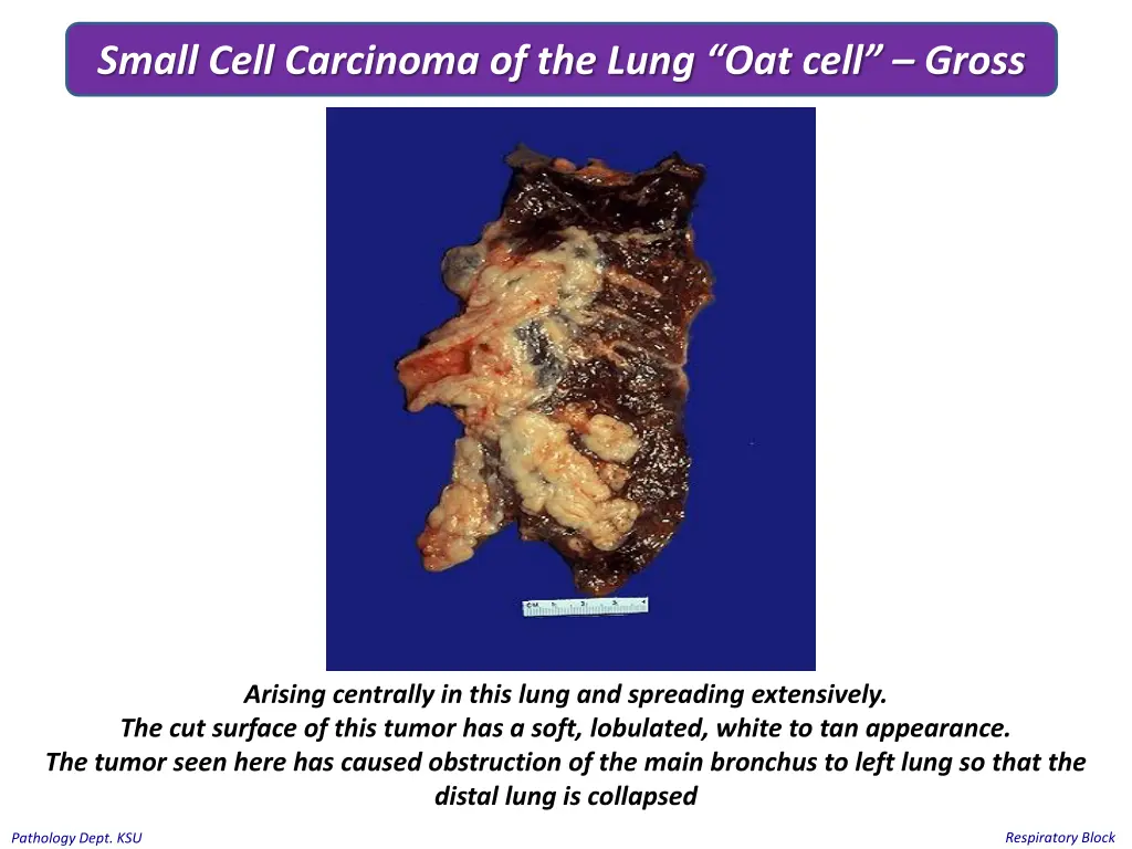 small cell carcinoma of the lung oat cell gross