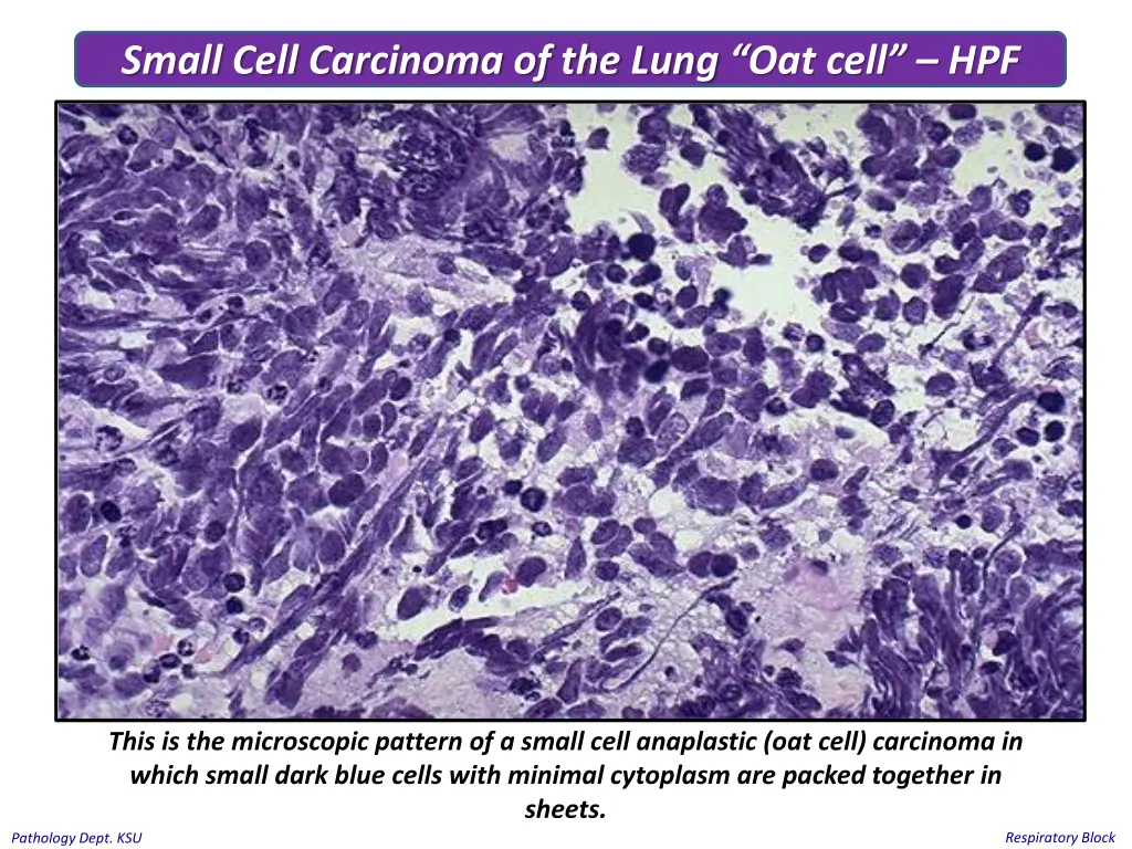 small cell carcinoma of the lung oat cell hpf