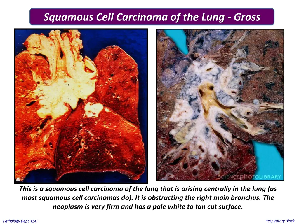 squamous cell carcinoma of the lung gross