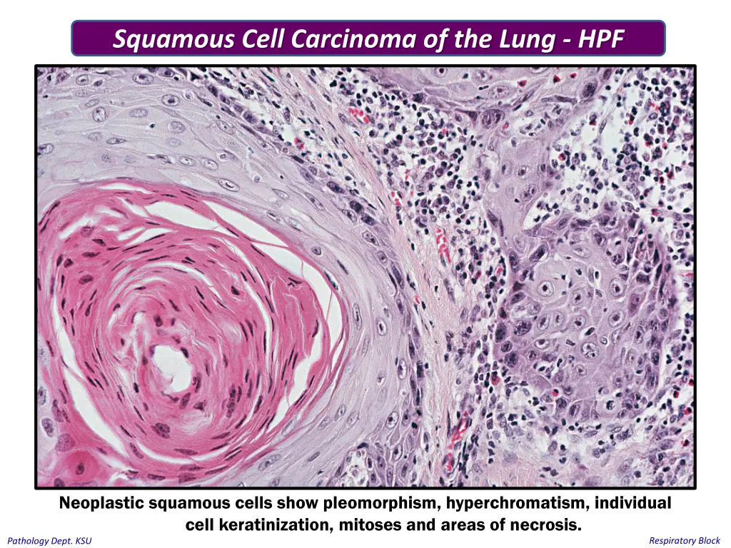 squamous cell carcinoma of the lung hpf 1