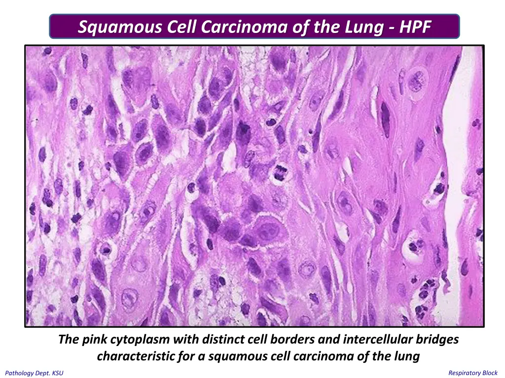 squamous cell carcinoma of the lung hpf 2