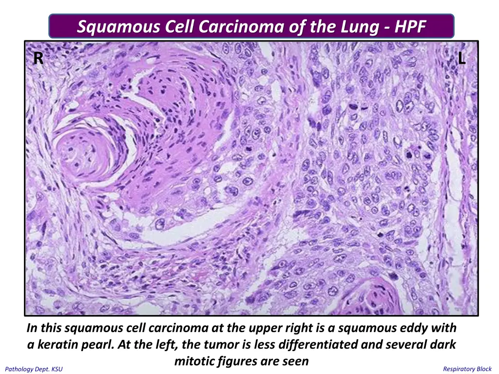 squamous cell carcinoma of the lung hpf