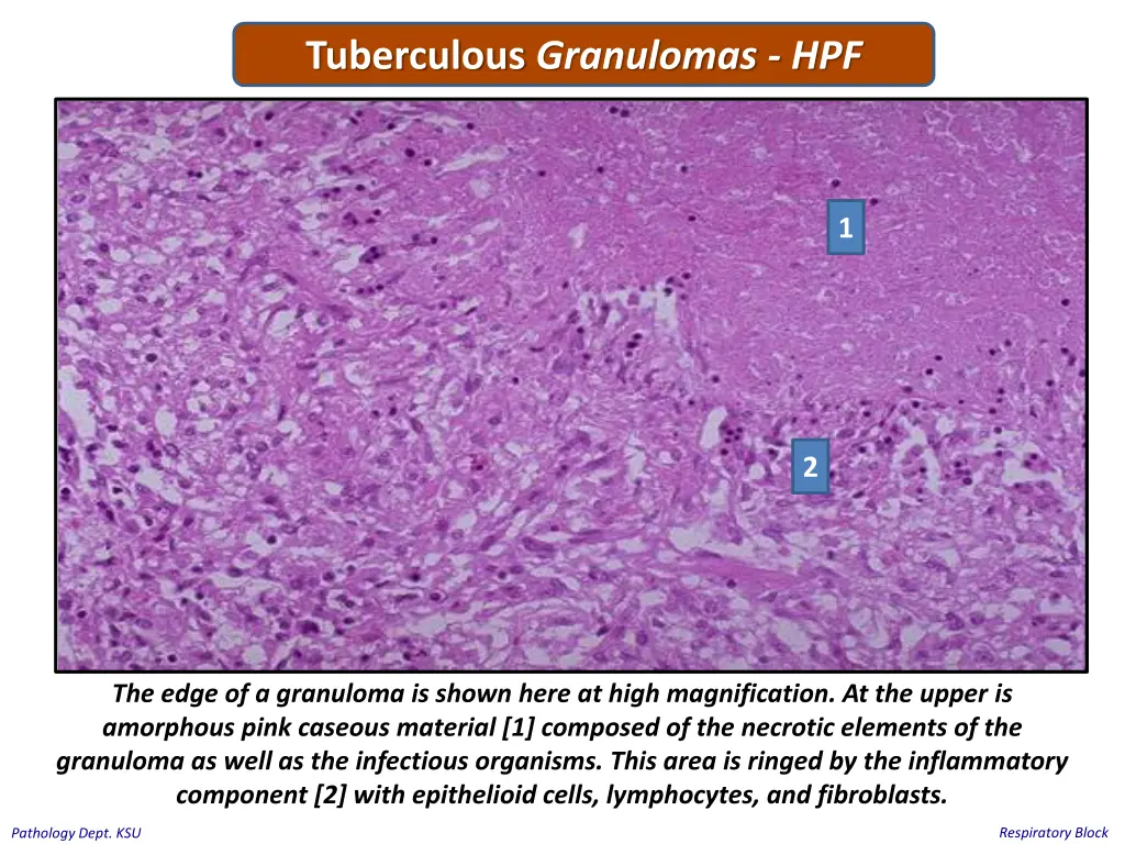 tuberculous granulomas hpf 1