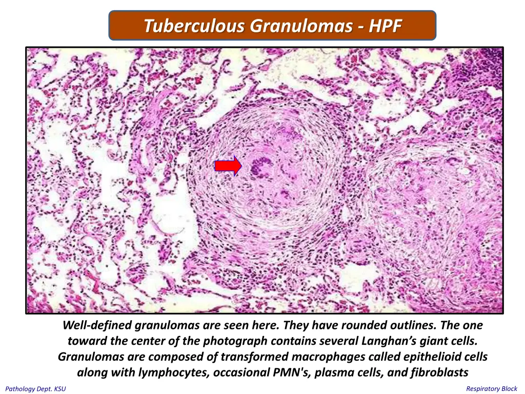 tuberculous granulomas hpf