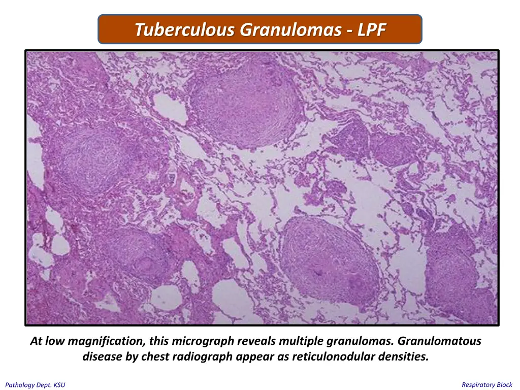 tuberculous granulomas lpf