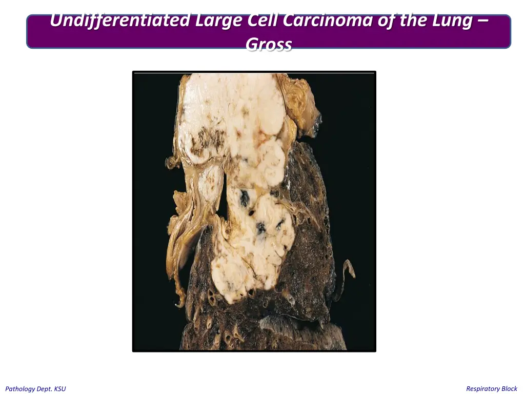 undifferentiated large cell carcinoma of the lung